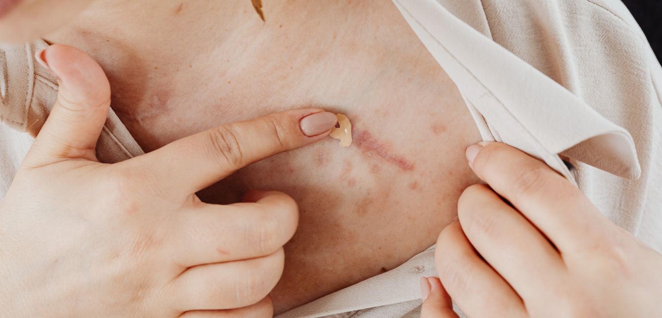 Blizny w branży beauty – czy rynek akceptuje niedoskonałości?